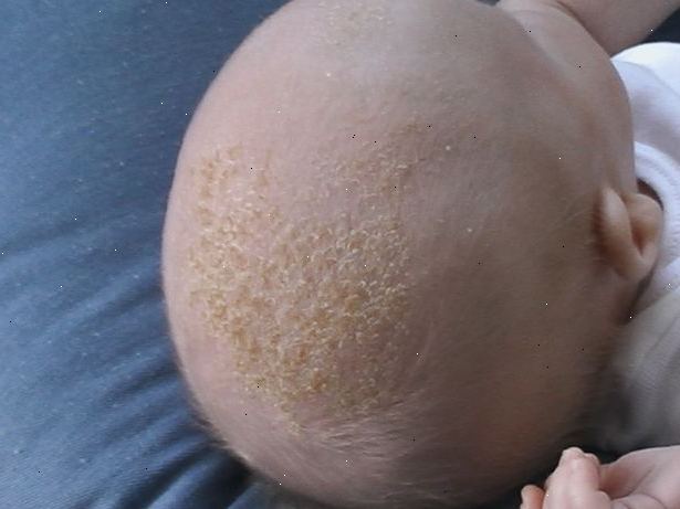 Inte alla barn upplever mjölkskorv. Lätt sandskädda bomullstuss på området för barnets huvud med tecken på mjölkskorv.